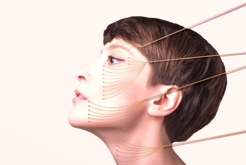 thread-lift-treatment